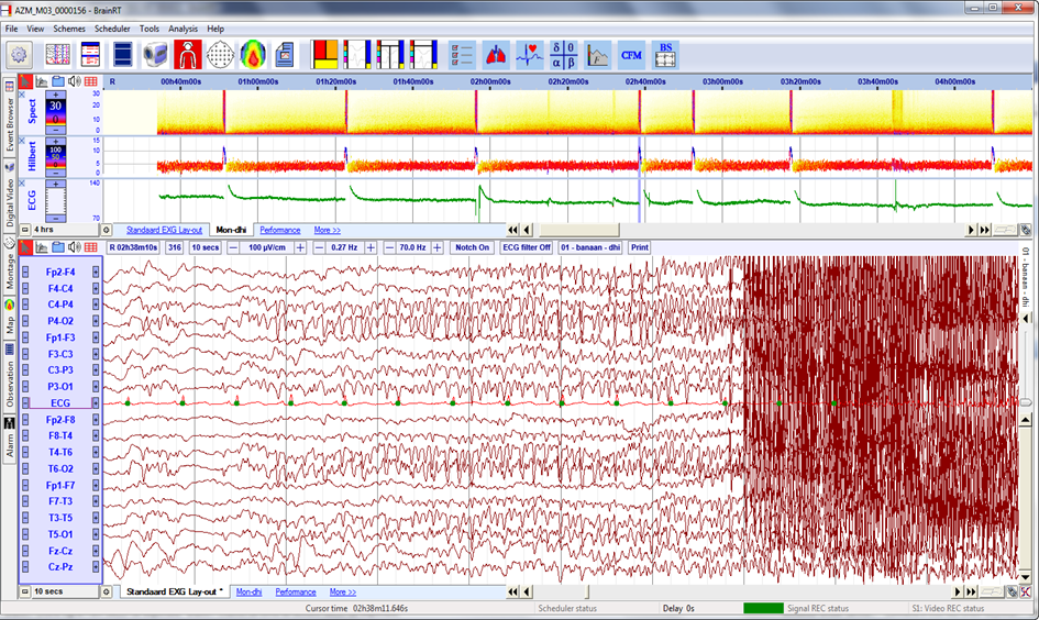 Example of Intensive Care Monitoring, with a very clear pattern of seizures visible on the spectrogram and Hilbert transform