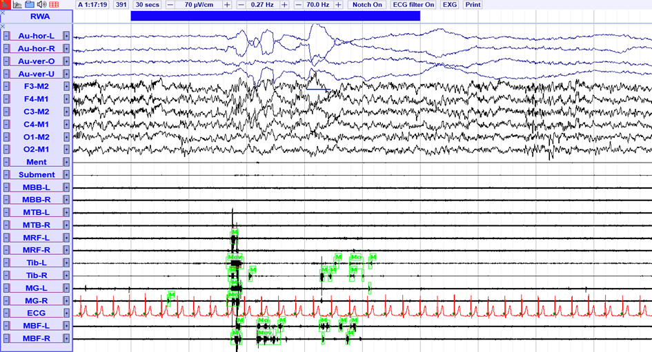 SleepRT™ example of the automatic detection of phasic EMG activity during REM sleep for a recording with 14 EMG channels. Each REM epoch is divided into 3 second epochs and evaluated for presence of phasic EMG activity